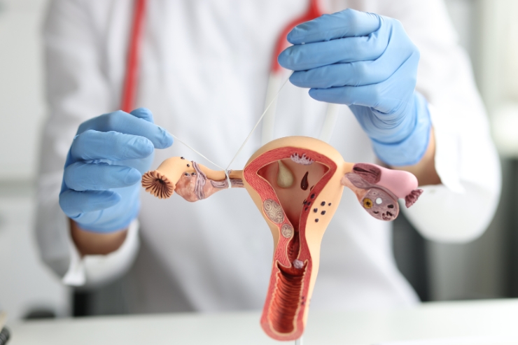Fibroid and Ovarian Cyst Treatment------34
